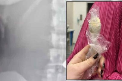 SON DAKİKA HABERLER: .Yoğurt yerken bir anda oldu, söylemeye utandı! Tam 17 santimetre büyüklüğünde, 2 gün vücudunda kaldı