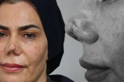 Burnu kırıldı, 4 operasyon sonrası hayatı kabusa döndü: Resmen hayattan koptum