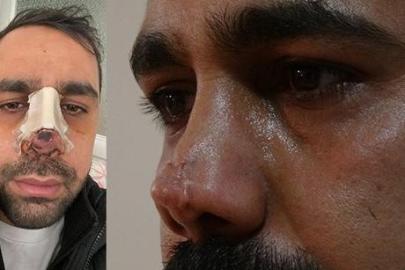 Burun ameliyatı sonrası hayatı kabusa döndü! 40 bin Euro'luk tedavi çıktı