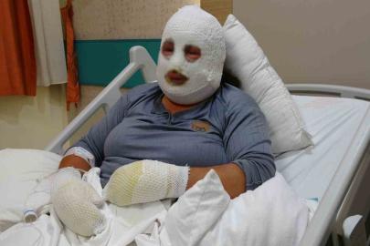 Kızını kurtarmak için alevlerin arasına girdi, kendisi de yandı